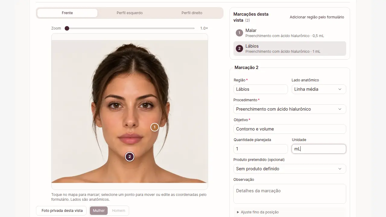 Mapa facial com duas marcações numeradas e o formulário da marcação preenchido; dados fictícios